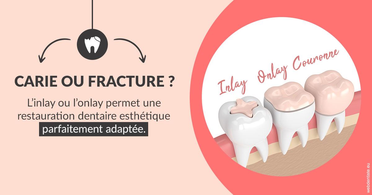 https://dr-nicolas-goossens.chirurgiens-dentistes.fr/T2 2023 - Carie ou fracture 2