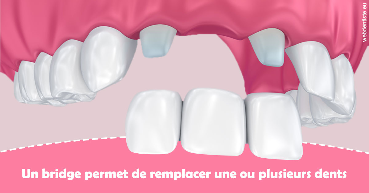 https://dr-nicolas-goossens.chirurgiens-dentistes.fr/Bridge remplacer dents 2