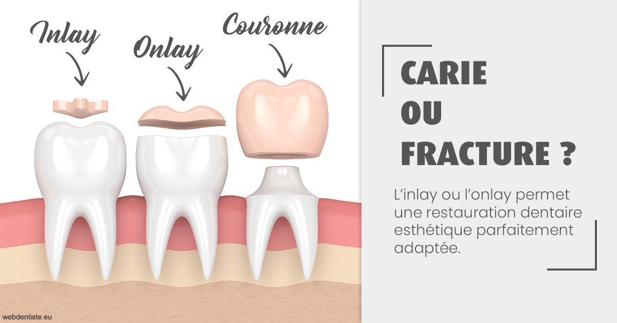 https://dr-nicolas-goossens.chirurgiens-dentistes.fr/T2 2023 - Carie ou fracture 1