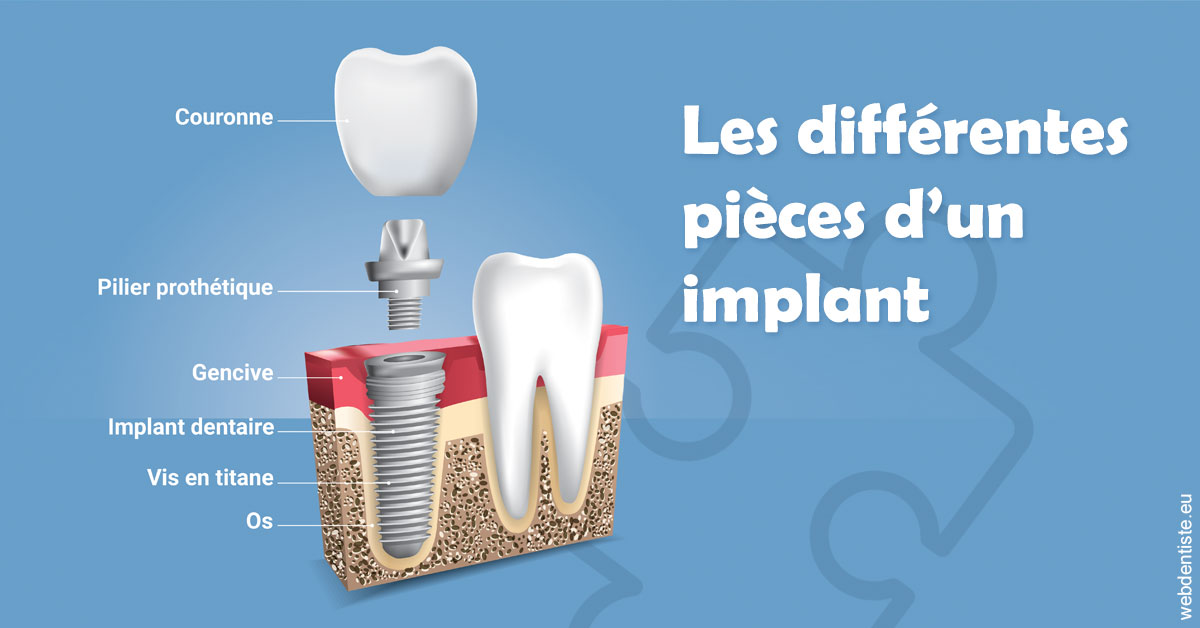 https://dr-nicolas-goossens.chirurgiens-dentistes.fr/Les différentes pièces d’un implant 1