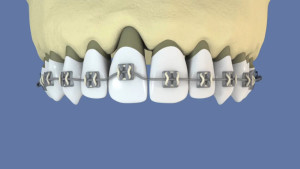 Extraction orthodontique et implant